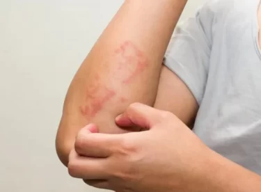 Alerji nedir belirtileri neler cildinizde kaşıntı ve kızarıklık varsa…